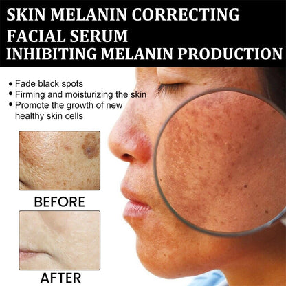 ✨Fast Dark Spot Remover-NESLEMY™ Melanin Correcting Facial Serum